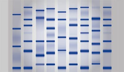 Eletroforese de proteínas resultados e quais doenças detecta Revista