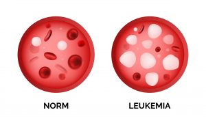 anemia pode virar leucemia, anemia pode matar, anemia mata?, anemia vira leucemia, anemia vira leucemia, anemia tem cura, anemia causa leucemia, anemia mata, anemia sintomas iniciais, doenças causadas pela falta de ferro,anemia forte, qual a leucemia mais perigosa, anemia e leucemia, sintomas anemia profunda, anemia falciforme pode virar leucemia, imunidade baixa pode causar leucemia, anemia y leucemia, como evitar a leucemia, anemia pode causar leucemia, anemia profunda tem cura, anemia leucemia, o que anemia pode causar, como, diagnosticar anemia, o que pode causar leucemia, como pegar leucemia, leucemia falciforme, o que a anemia pode causar se não for tratada, como cuidar da anemia, causa leucemia, o que e anemia?, como ter leucemia, anemia o que pode causar, anemia por falta de ferro pode virar leucemia, o que é anemia aguda, anemia leva a leucemia, o que provoca leucemia, o que é leucemia tem cura, anemia, plaquetas baixas, sintomas de anemia, hemacias, falta de ar, hemoglobina baixa, infecção no sangue, leucemia tem cura, cancer no sangue, falta de ar o que pode ser