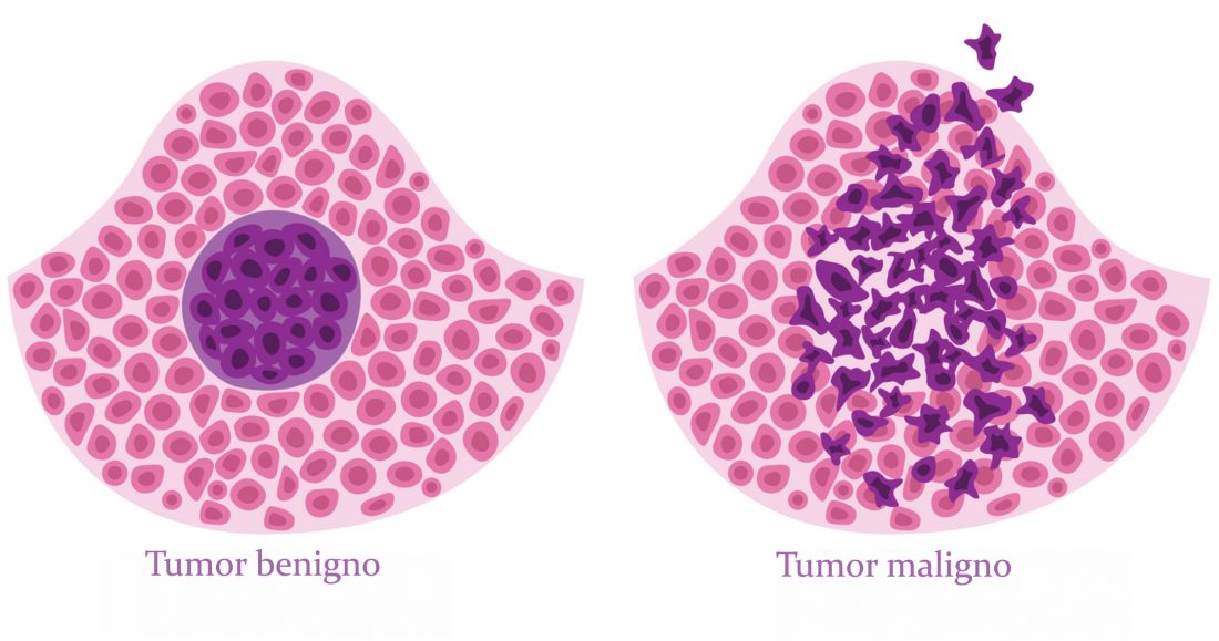 Diferencias Entre Nódulo Y Tumor – CGMQHV