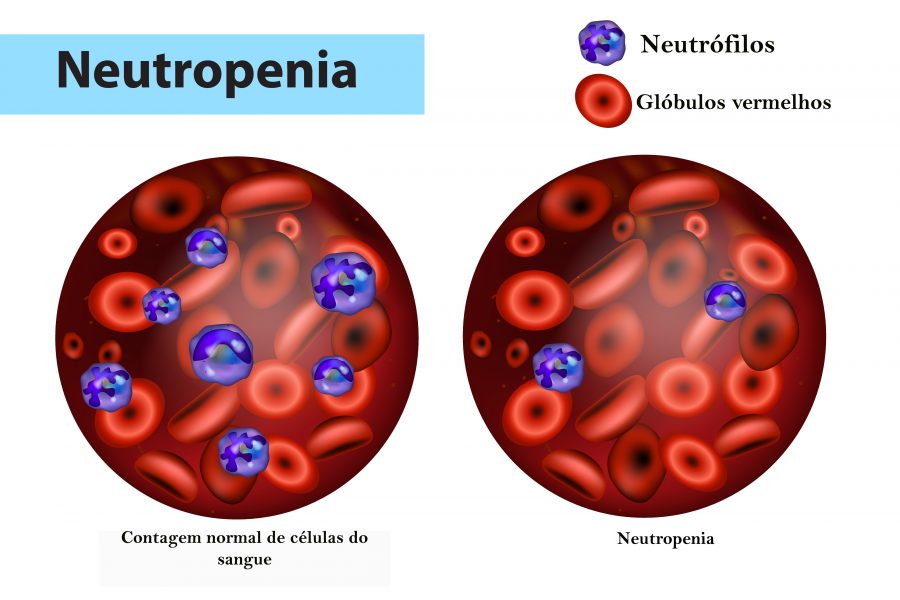 Neutropenia Relativa E Absoluta - RETOEDU