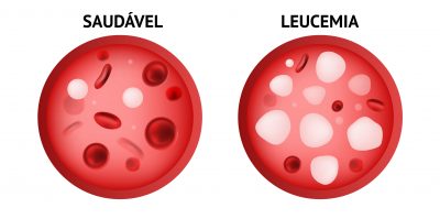 qual a leucemia mais perigosa , manchas roxas de leucemia doem, como se pega cancer, imunidade baixa pode causar leucemia, sangramento na gengiva leucemia, sangramento na gengiva leucemia, leucemia prevenção, prevenção da leucemia, prevenção para leucemia, leucemia causas sintomas e prevenção, prevenção de leucemia, leucemia causas, o que causa a leucemia, o que causa leucemia, causas da leucemia, leucemia mieloide aguda fatores de risco, fatores de risco da leucemia, fatores de risco leucemia, fatores de risco para leucemia, fatores de risco para leucemia mieloide aguda, leucemia fatores de risco, plaquetopenia, o que é plaquetopenia, plaquetas baixas, plaqueta baixa, plaquetas baixas o que pode ser