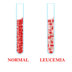 leucemia tem cura, leucemia, sintomas de leucemia, leucemia sintomas, sintomas leucemia, o que é leucemia, leucemia tem cura, plaquetas baixas causas, leucemia linfoide cronica, leucemia linfocítica crônica, leocemia, leucemias, leucemia cronica, o que causa leucemia, leucemia tipos, leucocitos baixos tratamento, leucemia causas, leucemia o que é, quais os sintomas da leucemia, causas da leucemia, sinais de leucemia, celulas mieloides, tratamento leucemia, leucemia diagnostico, tratamentos para leucemia, tratamento para leucemia, leucemia no sangue, leucemia linfocítica, cancer no sangue sintomas, leucemia é cancer, cancer da febre, tratamento da leucemia, llc o que é, leucocitos alterados, leucemia tem cura?, oq é leucemia, leucemia cronica tem cura, pessoas com leucemia, cancer na medula ossea, leucemia mata, cancer de medula ossea, oque e leucemia, cancer leucemia, leucemia no sangue tem cura, o que é leucemia aguda, leucemia tratamento, tratamento da leucemia, tratamento leucemia, tratamento para leucemia, tratamento de leucemia, como tratar leucemia, como curar leucemia, remedio para leucemia, medicamentos para la leucemia, cancer no sangue tem cura, quimioterapia leucemia, medicamentos para leucemia, leucemia aguda tem cura, transplante de medula leucemia, o que fazer quando a quimioterapia nao resolve, leucemia linfoide cronica tratamento, leucemia linfoide aguda tempo de vida, leucemia aguda tem cura, leucemia mieloide aguda tem cura, leucemia cronica tem cura, leucemia linfoide aguda tem cura, leucemia mieloide cronica tem cura, leucemia infantil tem cura, leucemia lla tem cura, leucemia porcentagem de cura, chances de cura da leucemia, leucemia tratamento cura, leucemia cura com quimioterapia, leucemia idosos tem cura, tratamento da lmc, tratamento para LMA, tratamento de LLA