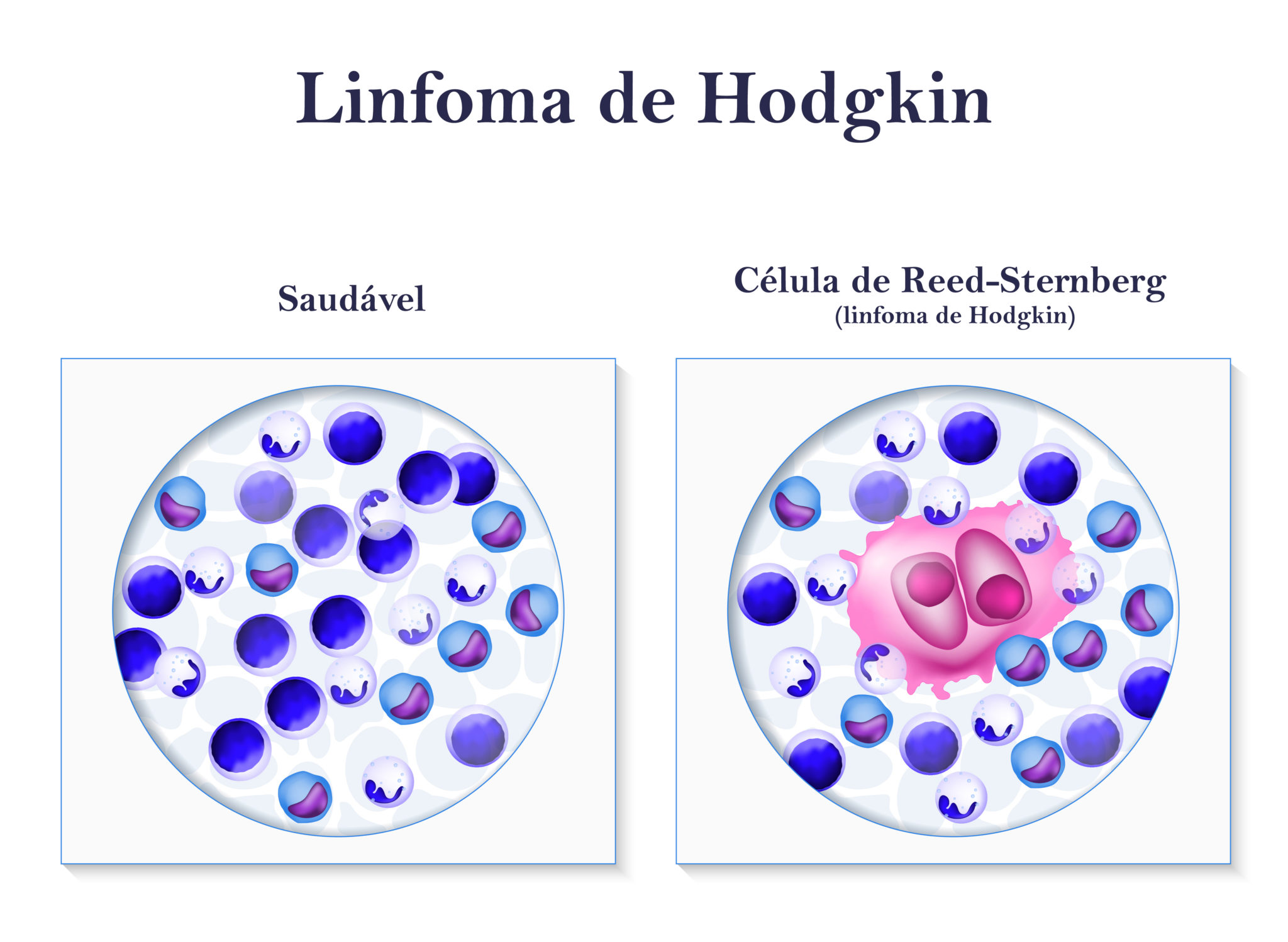 Linfoma não-Hodgkin agressivo versus indolente -RevistaOnlineABRALE
