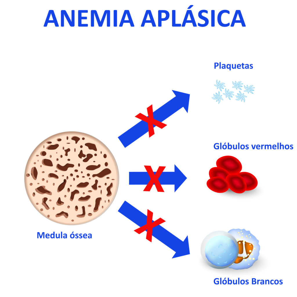 Tratamentos Para Anemia Aplásica Como Funcionam Revista Online Abrale 4908