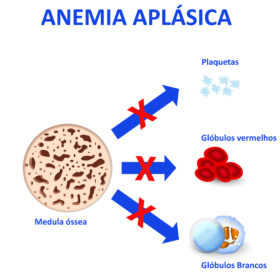 anemia aplástica, o que é anemia aplástica, anemia aplásica caracteristicas hemograma, anemia aplásica idiopática, síntomas de anemia aplásica, anemia aplásica grave, anemia aplásica idiopática sintoma, anemia aplásica severa, anemia aplástica grave, anemia aplástica sintomas, sintomas de anemia aplástica, anemia aplástica tem cura, tratamentos para anemia aplástica, anemia aplástica megaloblástica ou ferropriva, como é feito o diagnóstico da anemia aplástica, anemia aplástica causas, anemia aplástica severa, anemia aplástica adquirida, anemia aplástica definição, anemia aplástica idiopática, anemia aplástica o que é, tratamentos para anemia aplásica, anemia, doença autoimune, anemia aplasica, anemia aplástica, predinisona, Ciclosporina, atg, gat, atg de cavalo, gat de cavalo, atg de coelho, gat de coelho, pcdt