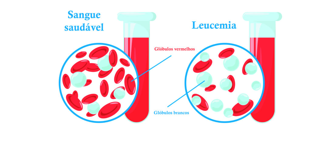Comparação Entre Um Sangue Saudável E Um Sangue Com Leucemia