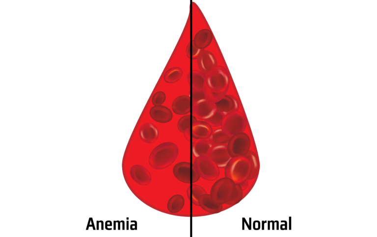 Hemograma no mieloma múltiplo - Revista Online ABRALE