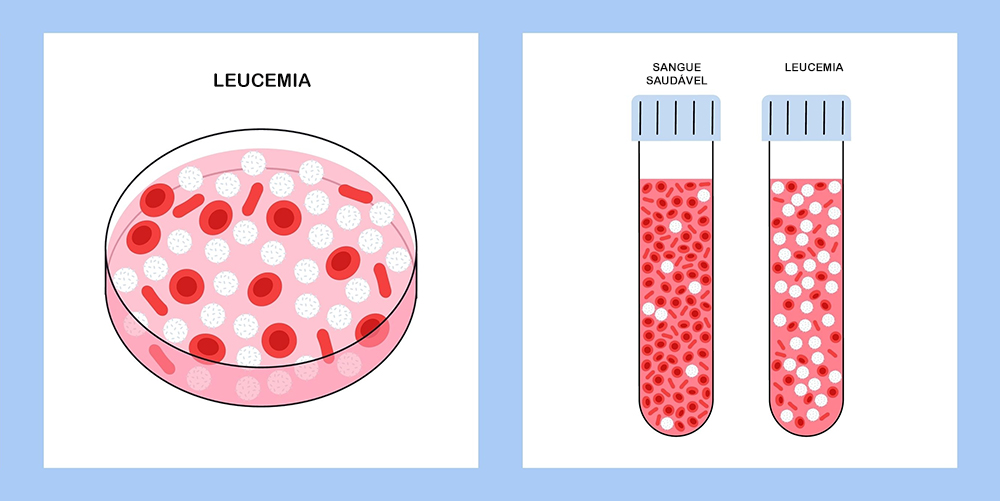 Comparação De Um Sangue Saudável E O Hemograma De Uma Pessoa Com Leucemia