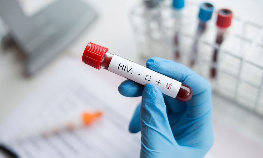 Teste Positivo Para HIV E Linfoma