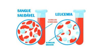 Linfócitos e leucócitos baixos ou altos: quando se preocupar - Revista ...