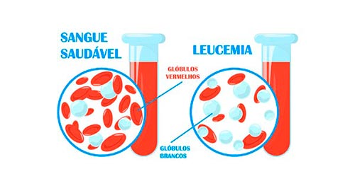 Comparação De Sangue Saudável E Sangue Com Leucemia