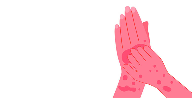 Coceira pelo corpo: quando é linfoma? - Revista Online ABRALE
