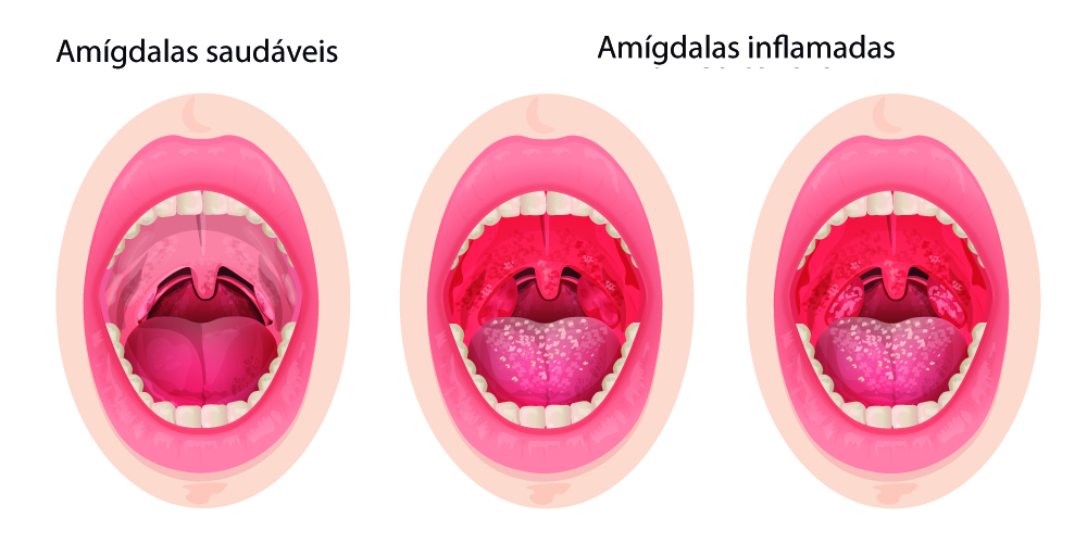 Representação Da Amigdalite, Que é Uma Das Doenças Do Sistema Linfático