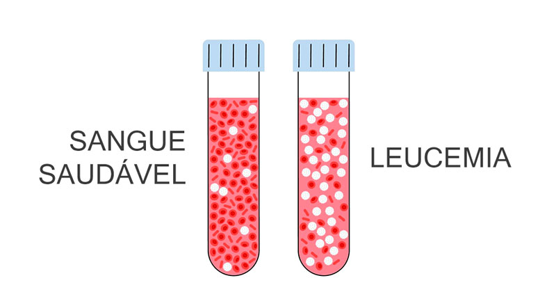 Exame De Sangue Com Leucemia