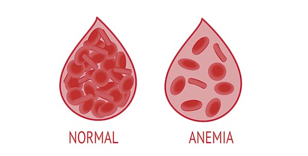 Mielofibrose e anemia