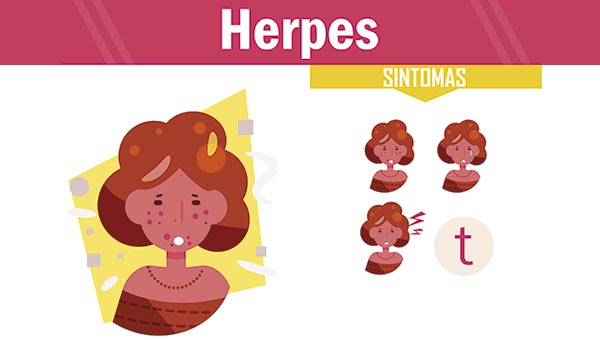 Sintomas De Herpes Zoster