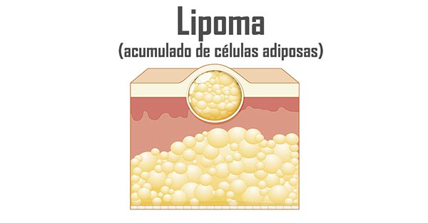 Descrição do que é um linfoma