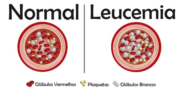 Diferença Entre Leucemia E Anemia