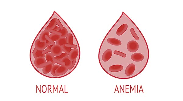 Anemia No Sangue