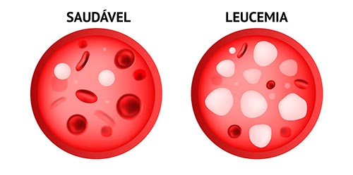 Leucemia no sangue por conta do contato com formol