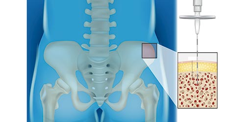 Ilustração de biópsia de medula óssea para diagnóstico de leucemia mieloide aguda recaída