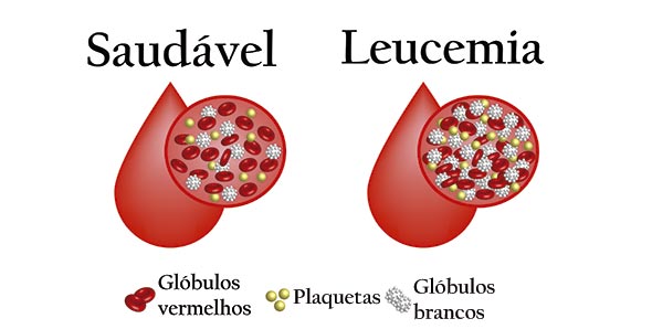 Imagem comparando células sanguíneas saudáveis com células de leucemia, ilustrando que a falta de vitamina B12 não causa leucemia.