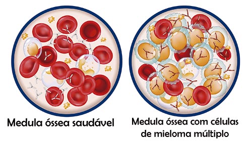 Imagem comparando como é uma medula óssea saudável e como ela fica quando há alguma doença.