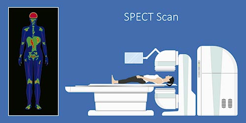 Ilustração de um procedimento de SPECT Scan destacando regiões ativas em um corpo humano e mostrando o posicionamento do paciente para diagnóstico de linfoma está avançado.