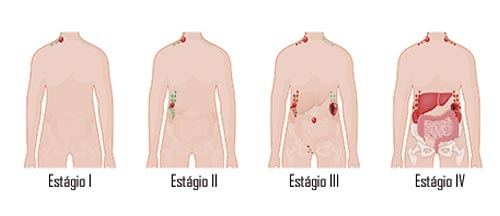 Diagrama do estadiamento do linfoma de Hodgkin, explicando os diferentes estágios da doença.