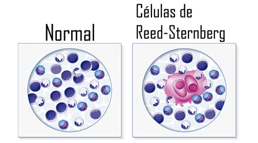 Comparação microscópica entre células normais e células de Reed-Sternberg, destacando a diferença crucial para o diagnóstico do linfoma de Hodgkin.