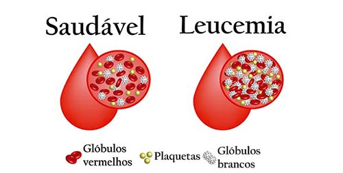 Ilustração comparativa entre uma célula sanguínea saudável e outra com leucemia destacando as alterações no hemograma, como os glóbulos vermelhos normais contra o aumento dos glóbulos brancos na leucemia.