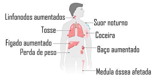 Diagrama do corpo humano indicando sintomas do linfoma de Hodgkin, como linfonodos aumentados, suor noturno, tosse, coceira, perda de peso e baço aumentado.