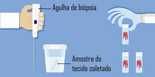 Biópsia de linfonodo para diagnosticar o linfoma