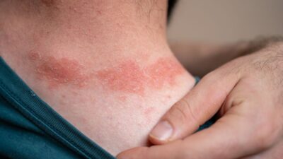 alergia