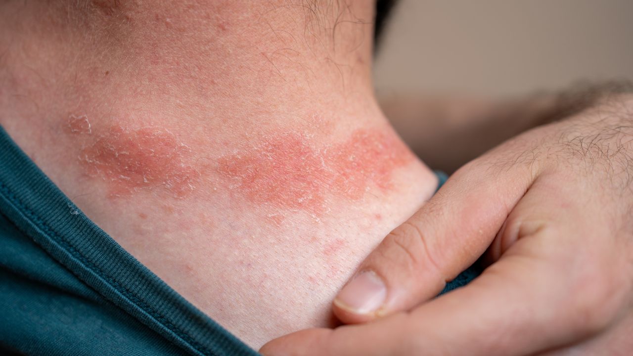 alergia