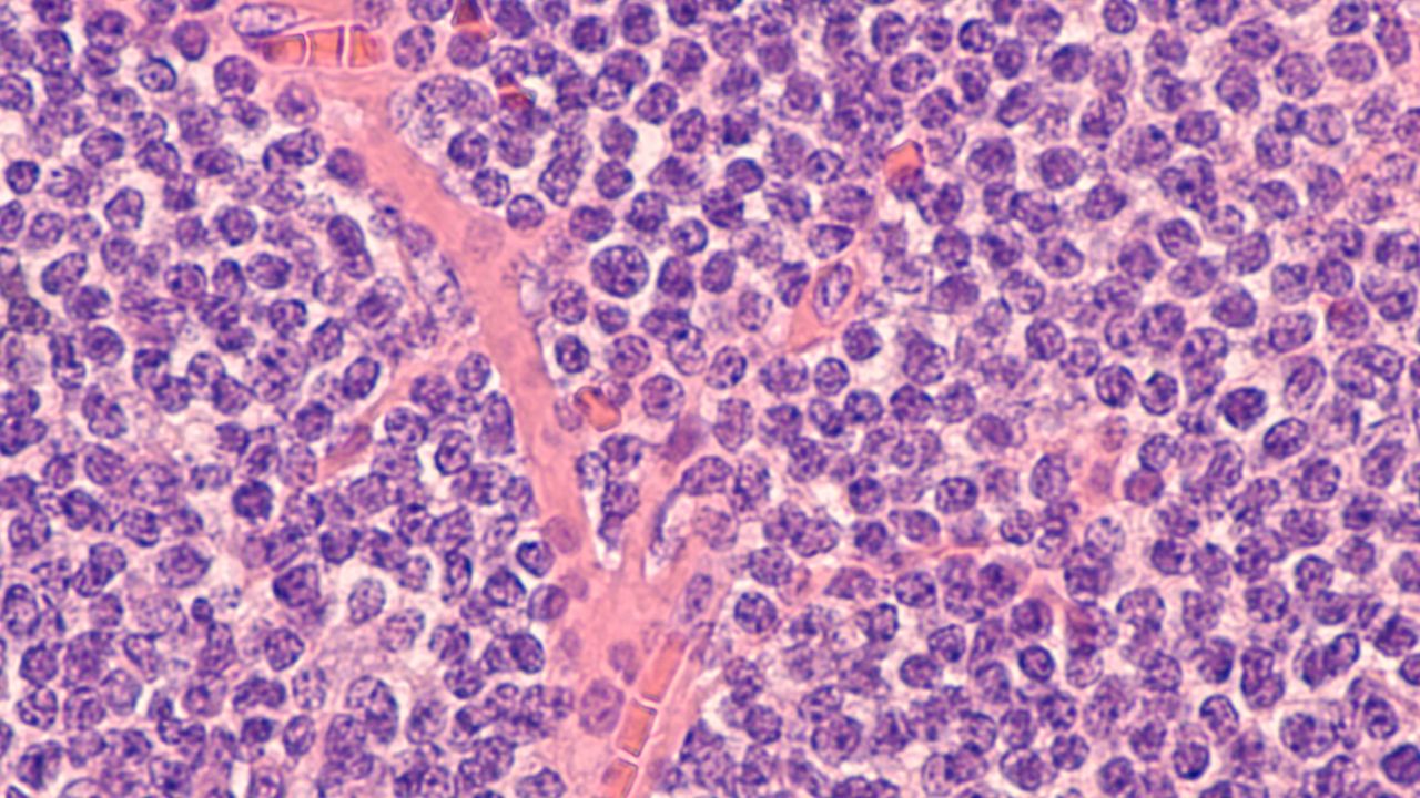 linfoma
