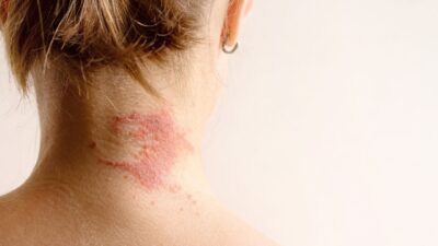 Todo paciente que fizer o TMO terá DECH?